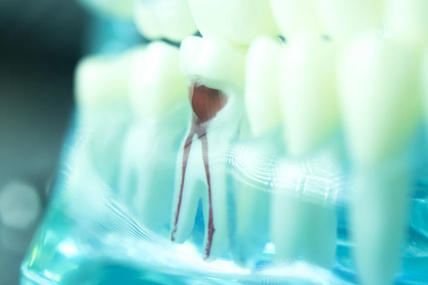 Root Canal Therapy in Blue Bell, PA | Rituals Dental Wellness & Aesthetics
