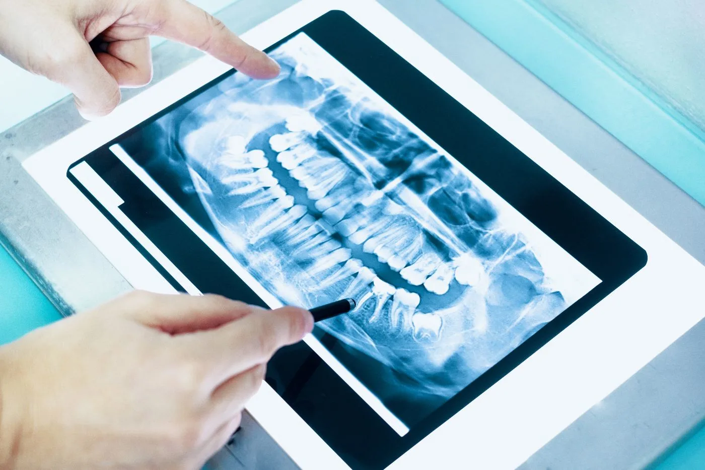 Tooth Extractions in Blue Bell, PA | Rituals Dental Wellness