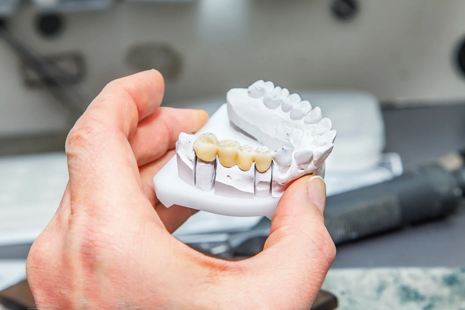 Dental Bridges in Blue Bell, PA | Rituals Dental Wellness & Aesthetics