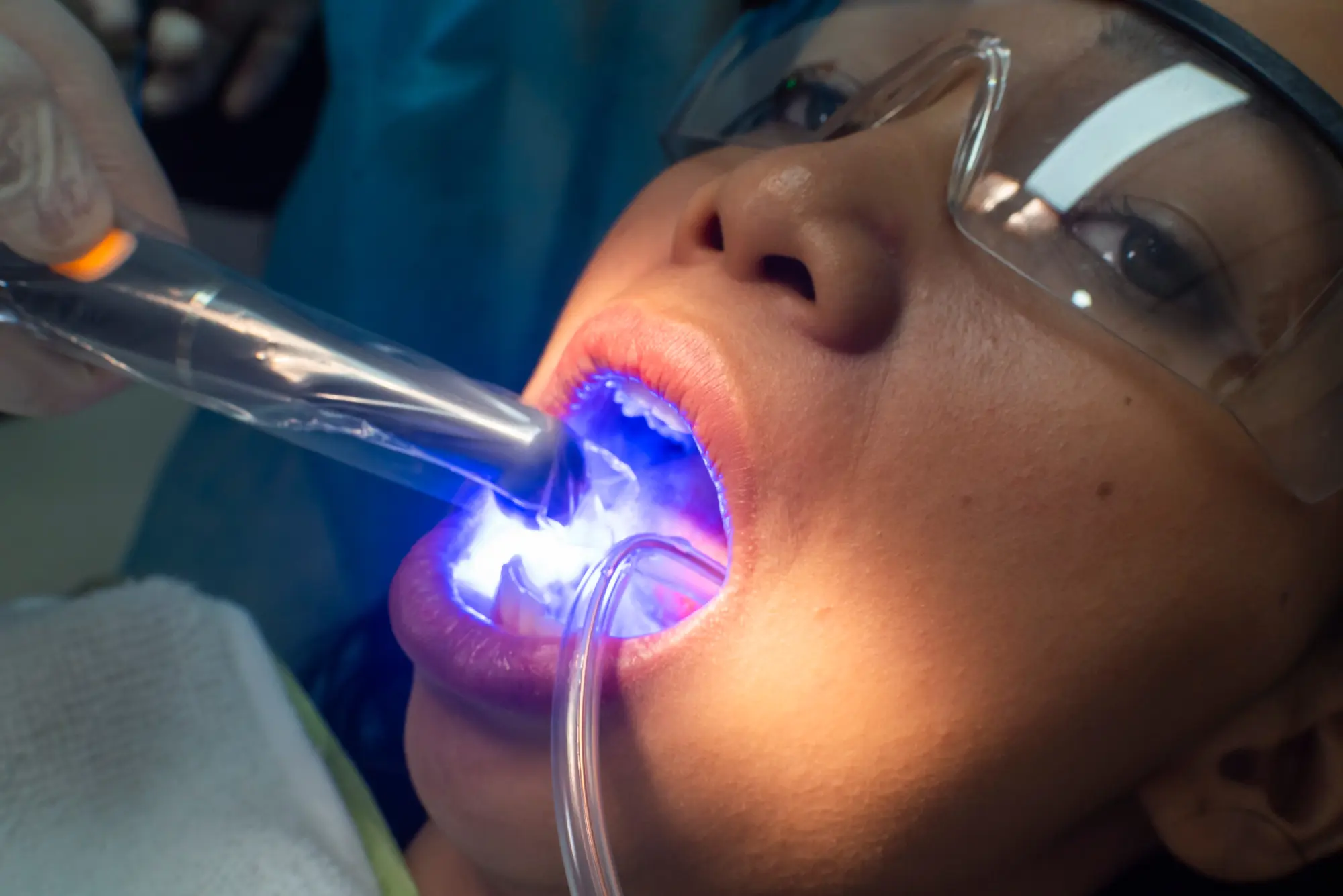 Dental Bonding procedure in Blue Bell, PA